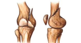 Alimentos para curar las fracturas