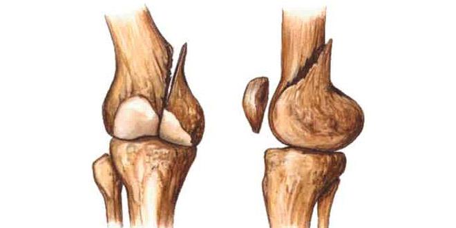 Alimentos para la curación de huesos fracturados