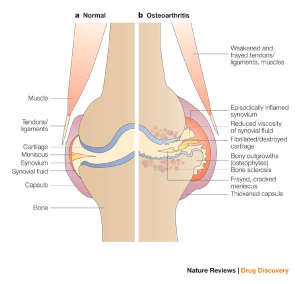 cartilago-osteoartritis