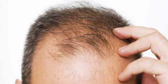 Pérdida de cabello hombres