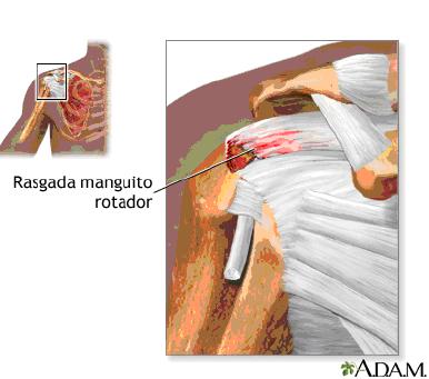 rotura-manguito