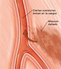 rabdomiolisis