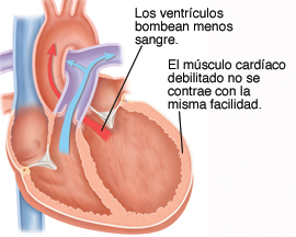 miocardio