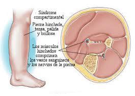 sintomas-sindrome-compartimental