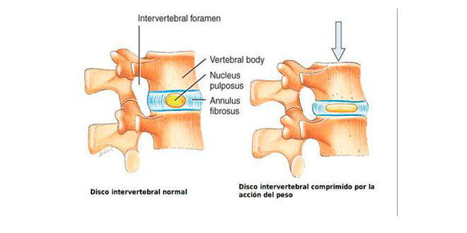 discos-intervertebrales