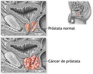 prostata