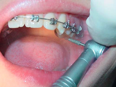 Protectores bucales y TTM Protectores bucales