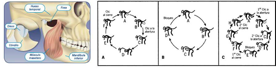 Subluxación subluxacion