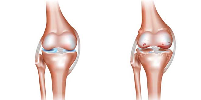 Osteoartritis
