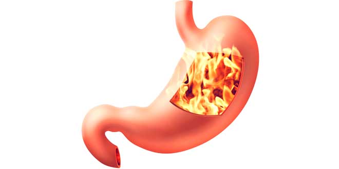 Inflamación del estómago