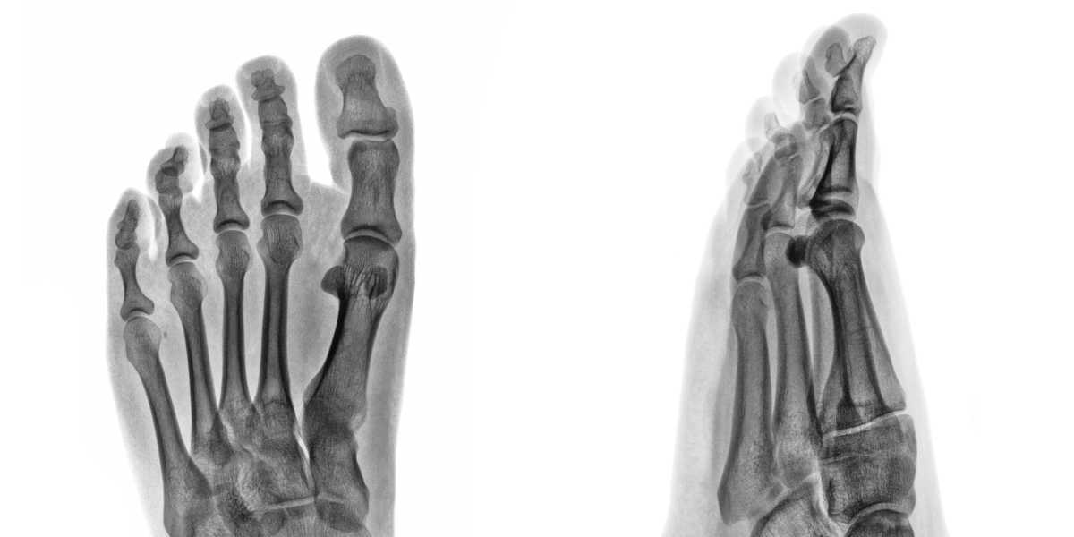 ¿Cómo beneficia el calcio a tus huesos?