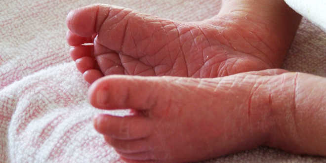 Dermatitis atópica causas Dermatitis atópica causas