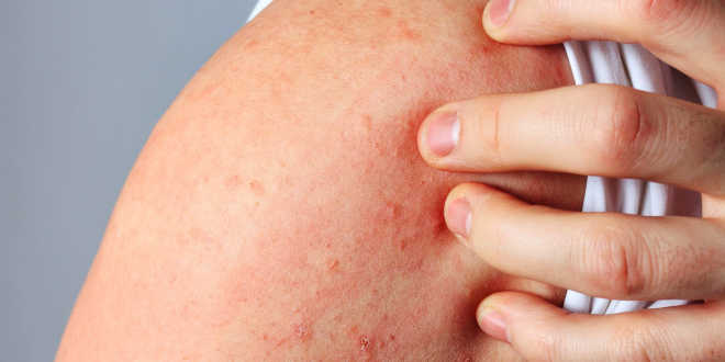 Dermatitis por contacto Dermatitis por contacto