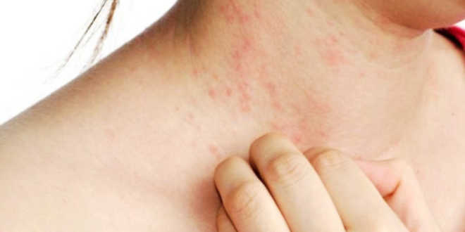 Dermatitis – Causas, tipos y cómo tratar dicha afección de la piel
