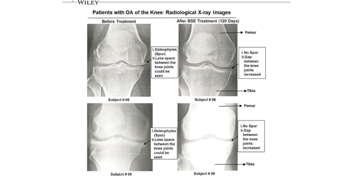 Amélioration du cartilage