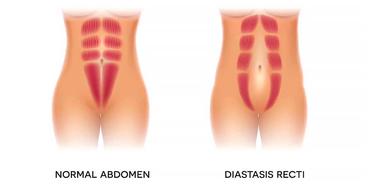 abdomen avec diastasis vs abdomen normal