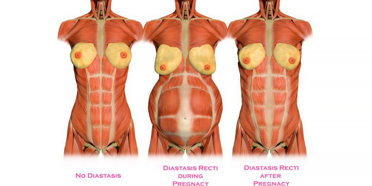 Grossesse et Diastasis Abdominale