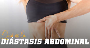 Diástasis Abdominal