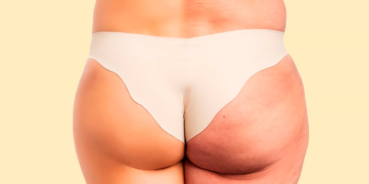 Réduire la Cellulite