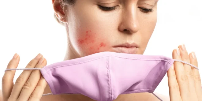 ¿Qué es el Maskné y cómo puedo tratarlo? ¿Qué es el Maskné y cómo puedo tratarlo?