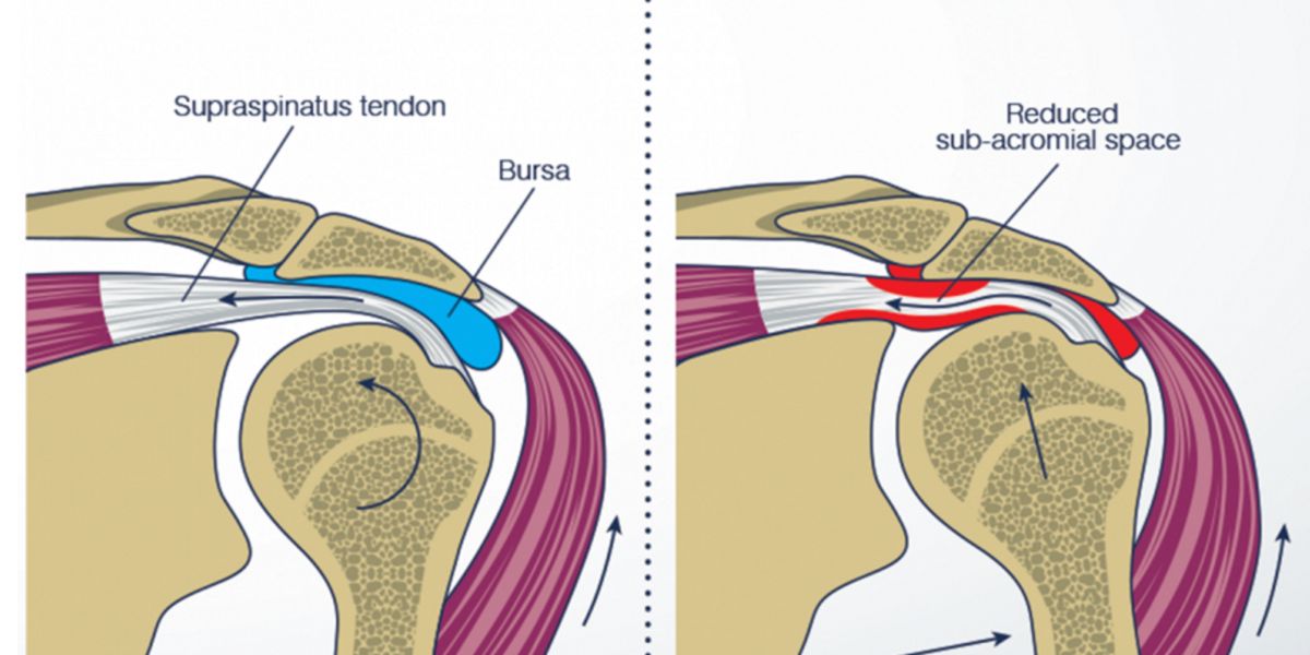 Tendinitis y Bursitis